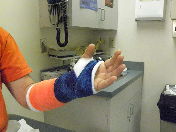 person with a hand cast after an injury